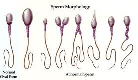 sperm abnormalitiess