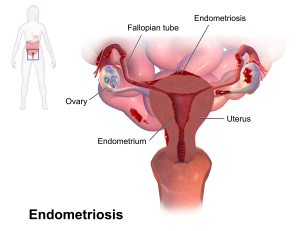 Penyakit Pelumpuh Pelvis – Endometriosis  Drsharifah's blog