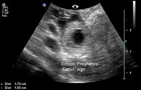 Kehamilan Ektopik (Ectopic pregnancy)  Drsharifah's blog